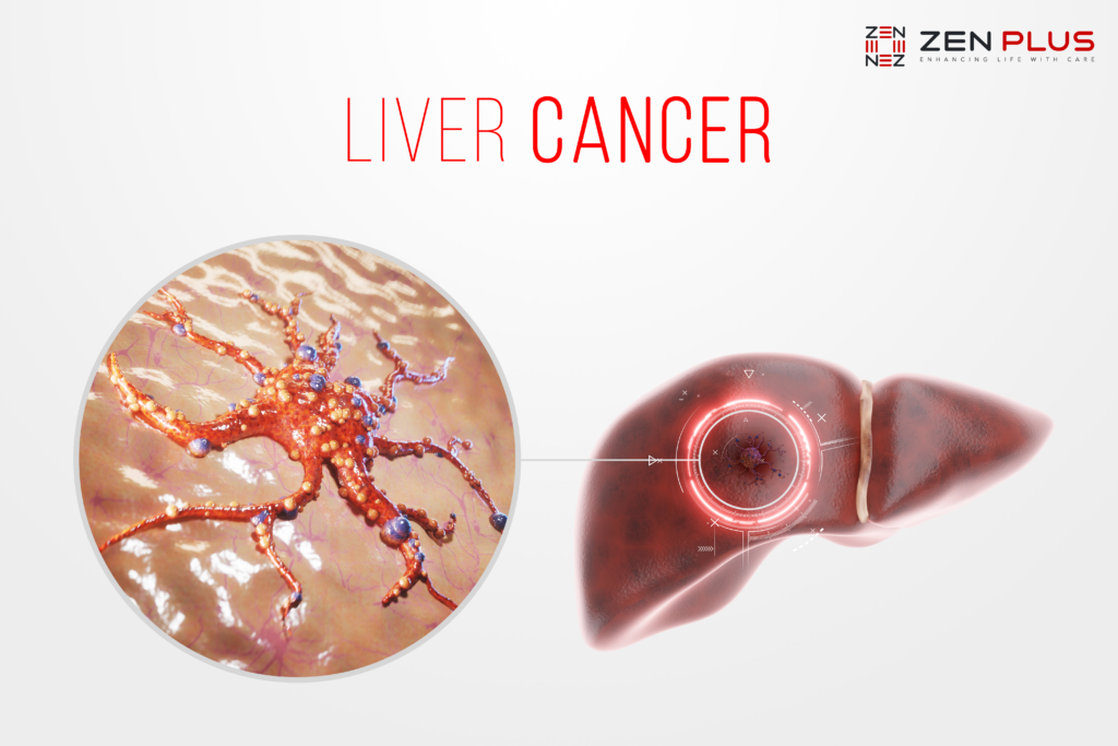 Knowing the Causes and Signs of Liver Cancer