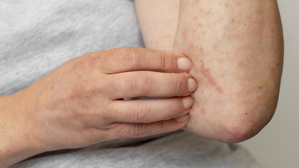 Understanding Pityriasis Rosea: Everything You Need to Know