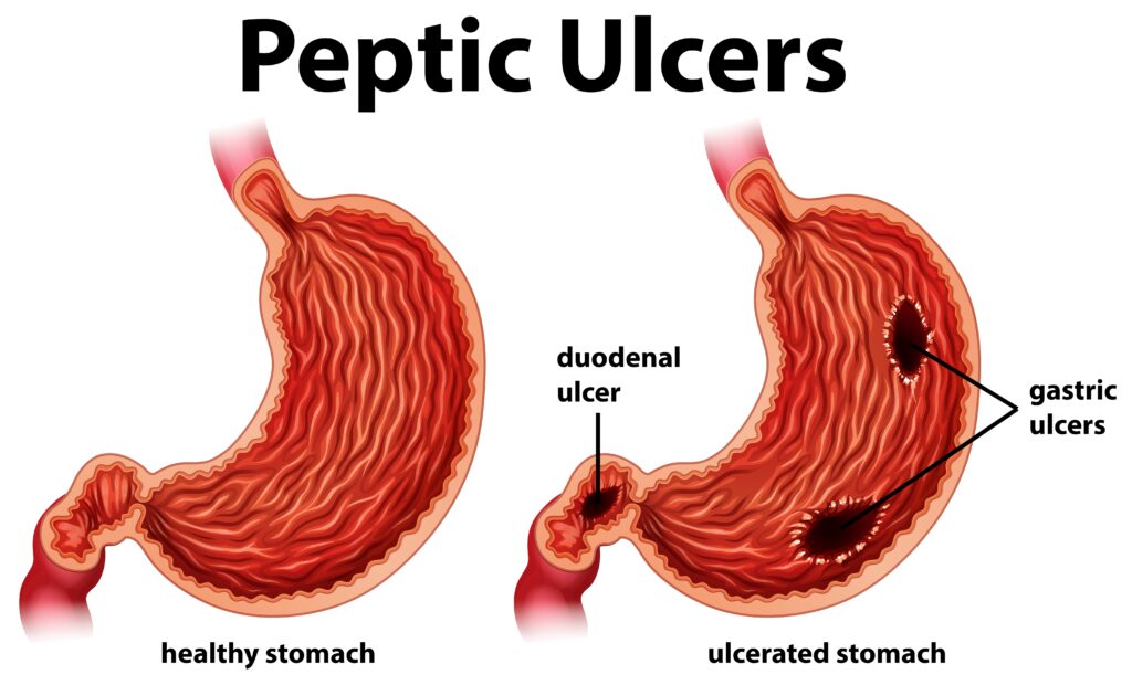 Ulcers 101: Causes and Treatments You Need to Know